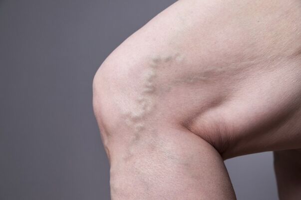 Varizes veias em mulheres