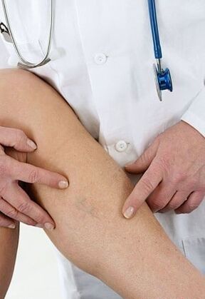 Varizes das extremidades inferiores