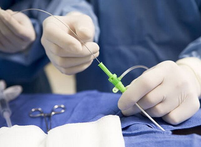 Ablação por radiofrequência