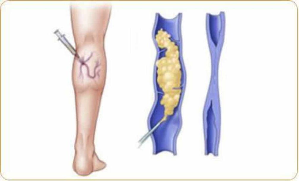 Um exemplo de procedimento de escleroterapia para varizes e um resultado claro